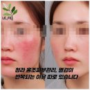 동서종합화장품 | [공지] 청라 홍조피부관리, 열감이 반복되는 이유 따로 있습니다