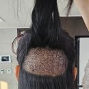 모래내약국 | 전주 모래네모발이식센터 리얼후기 1