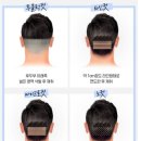 링크성형외과의원 | 광주광역시여자모발이식 M자모발이식후기 비절개마이크로컷 비절개라인컷 모닥터범의원 후기