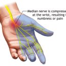 손목 터널 증후군(수근관 증후군) 이미지