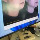 평창동피부과 60대 목주름 끝판왕 레디어스 덴서티 후기