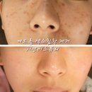 서면피부관리 미소뷰티 서면점에서 꿀피부 되찾았어요