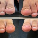 흥덕이마트 사거리(3단지) | 발톱관리 아크릴교정 후기! 파고드는 문제성발톱 1회...통증 사라진 기흥구 흥덕마을 소소한네일 케어추천