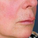 닥터탁성형외과의원 | 인중오목술 후기, 부작용이 걱정되는 분들은 읽어보세요. <성형외과 전문의 닥터탁 칼럼>