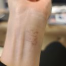 210129 | 타투 7차 제거 후기 (210129)