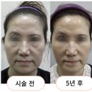 아름다운미탐의원 | 다크서클, 눈밑 필러, 하안검, 지방 재배치 고민자들이 꼭 알아야할 진짜 이야기