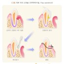 치주질환[잇몸질환]: K05 이미지