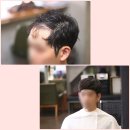 증모술 앞머리 탈모 고민해결 송파 성남 남자 붙임머리