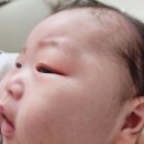 연세아름소아과의원 | 수원 설소대 소아과 신생아 시술 후기 (연세해맑은소아과)