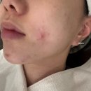 메스티 | 분당 피부관리 <메스티 분당서현점> 트러블케어 후기