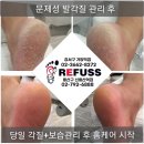 레푸스 이미지