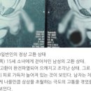 15세 소녀한테 고환 걷어차인 남자 고환 상태 ㄷㄷ(사진주의) 이미지