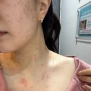 리샘한의원부천점 | 리샘한의원 편평사마귀 무제한 제거 내돈내산