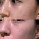 여드름 마스크팩 세멘시트 효과 후기 부작용