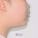 서울보스톤고른이치과의원 | 앞니가 나와보이는 입매 교정하기? 시흥 정왕동 치과