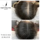 마음에점을찍다두피SMP 이미지