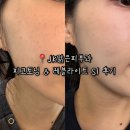 SI메디컬 | 부산 구서동 피코토닝 레블라이트 SI 레이져 기미치료 잘 하는 jk맑은피부과의원