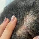 새순약국 | 니조랄 샴푸 가격 처방 정보 후기