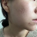 제이에스테틱((피부) | 천호 피부관리 제이라운지에스테틱 천호점에서 여드름 관리 받은 솔직 후기