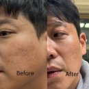 바디부스터짐 | 신사동피부과 온다리프팅 가격 통증 여드름 곰보 옅어진 2주 후기 (+ 엘리쥬 스킨부스터 추천)