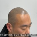 3018 | 대전두피페인팅 부작용 없는 곳 찾는 3가지