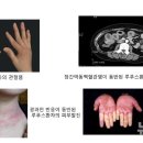 성모반점 이미지