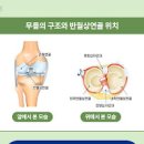 반월상 연골 파열 및 수술 (무릎 연골 찢어짐, 안쪽 통증) 이미지