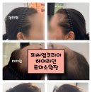 [혼주헤어라인] 두피SMP잘하는 피씨엘코리아(PCL KOREA) - 강남 헤어라인 받은 후기 [대만족]
