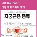 거대자궁근종은 어떻게 치료해야 할까. 이미지