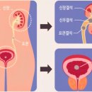 닥터철비뇨의학과의원 | ⧫요로 결석의 종류와 성분⧫