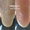 [포쉬네일 광주 수완점] 발각질 관리