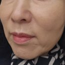 신논현 온다리프팅 울트라콜 상견례전 엄마 해준 후기