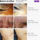 메디에스 | 일산사각턱보톡스로 청순갸름한 브이라인으로 변했어요-* 일산보톡스전문메디에스클리닉후기!