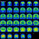 국시2차영상 Brain Perfusion SPECT (ECD) 이미지