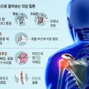 &#34;팔을 올리고 내릴때 통증?&#34; 힘줄 손상에 의한 어깨회전근개파열 이미지