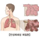 만성폐쇄성폐질환(COPD)/아산병원 자료 이미지