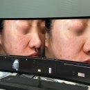 우노메디칼 | 바르는 스킨부스터 위코우노 효과, 주기 신논현역 피부과