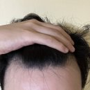 종로연세약국 | 종로 탈모병원 성지 탈모약 처방 및 광장시장 방문 후기