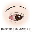 모세혈관 확장성 운동실조 증후군(Ataxia-telangiectasia syndrome) 유전질환이란? 이미지