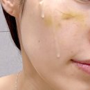 내돈내산 쥬베룩 스킨+볼륨 4cc | 붓기 통증 멍 부작용 결절 리얼 후기