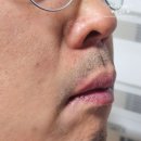 집톡스 | 반복되는 입술포진이 신경 쓰인다면 헤르톡스 후기