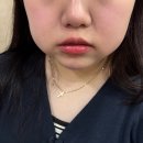 남원장 | 신논현역/강남역 :: 윤곽주사 갸름주사 1회 후기 (전후비교)