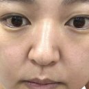 오롯의원 | 흑석동피부과 스킨부스터 엑소좀 +3자이마 레이저제모 내돈내산