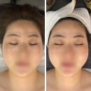 구암동565 | 대구 칠곡 피부관리, 더 빛나 스킨케어 슈텀프니들테라피 후기
