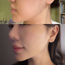 순자 | 강남 피부과 올타이트리프팅 나솔 순자랑 같은 병원에서 받은 후기