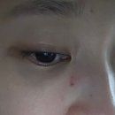 앵무새 물림 상처 대웅제약 이지에프새살연고 2개월 회복기