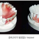 임플란트 - 보철재료의종류 , (금,세라믹) 이미지