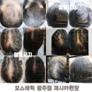 호연피부관리실 | 원형탈모, 탈모 되살려주는 모발생장술 후기 모스테틱광주
