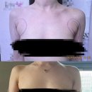[부유방수술 후기2]4주차 경과 사진후기 (혐주의)