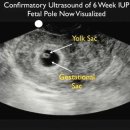 11 Intrauterine Pregnancy 이미지
